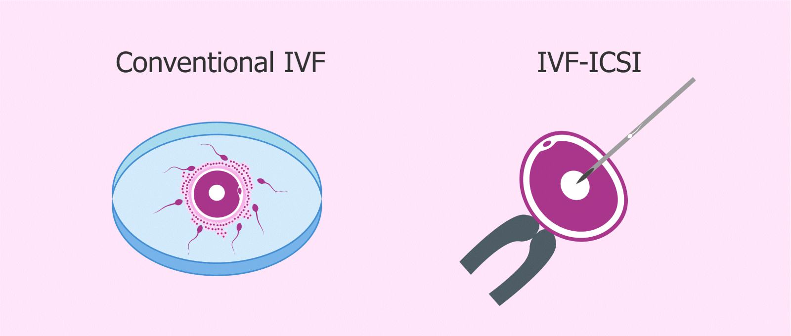 Sự khác biệt giữa IVF và ICSI 