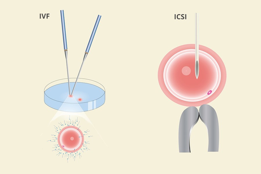 Sự khác biệt IVF và ICSI 
